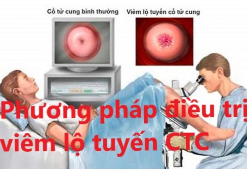 Cách điều trị bệnh viêm lộ tuyến cổ tử cung