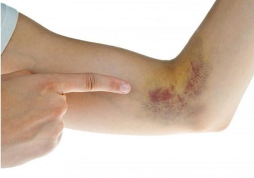 Bệnh xuất huyết giảm tiểu cầu có nguy hiểm không?