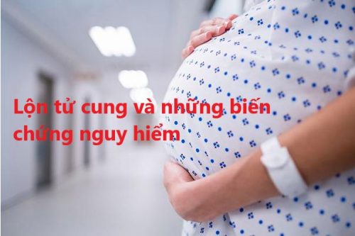 Lộn tử cung