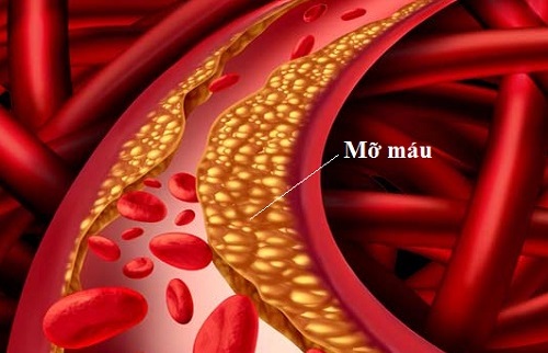 Mỡ máu như thế nào là cao? Làm sao để mỡ máu về chỉ số bình thường?