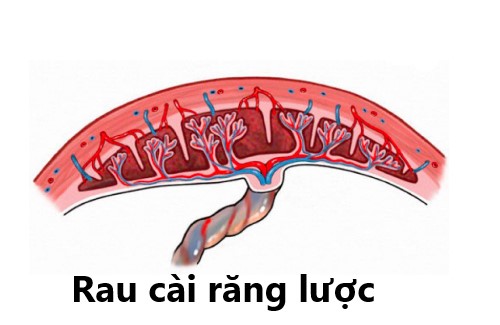 Rau cài răng lược – Bệnh lý sản khoa nguy hiểm đe dọa tính mạng mẹ bầu