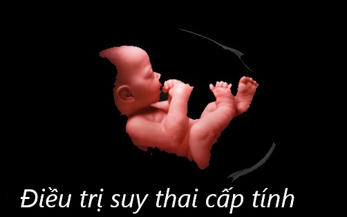 Điều trị suy thai cấp tính trong thời gian chuyển dạ