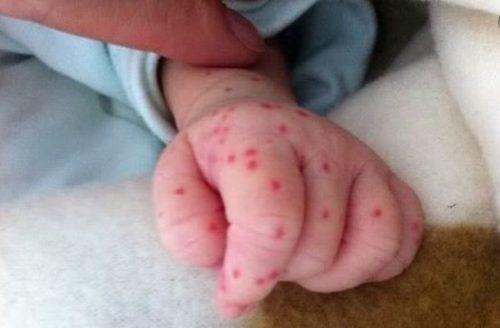 Bệnh xuất huyết giảm tiểu cầu là gì?