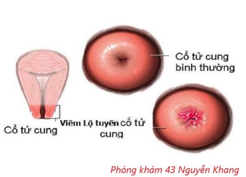 Viêm lộ tuyến cổ tử cung là gì ?