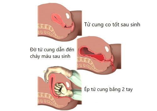Đờ tử cung – Tai biến sản khoa nguy hiểm cho mẹ bầu