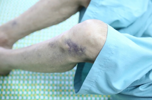 Xuất huyết giảm tiểu cầu: Những điều cần biết