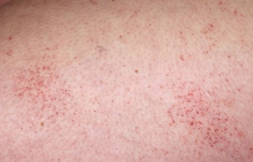 xuất huyết giảm tiểu cầu