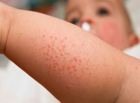Nguyên nhân gây bệnh xuất huyết giảm tiểu cầu tự phát