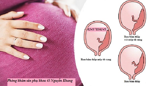 Giải đáp những thắc mắc của mẹ bầu về tình trạng nhau bám thấp