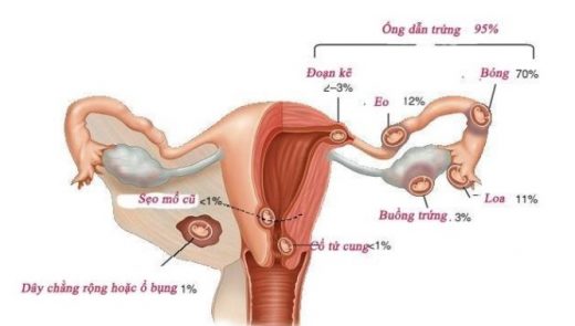 chửa ngoài tử cung