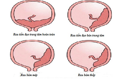 Rau bám thấp là hiện tượng gì?