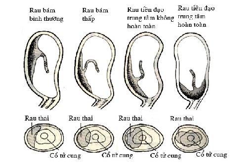 Bệnh lý rau tiền đạo ở phụ nữ mang thai và cách dự phòng