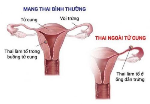thai ngoài tử cung
