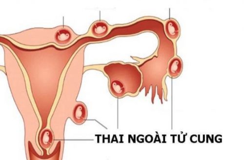 Những điều cần biết về chửa ngoài tử cung