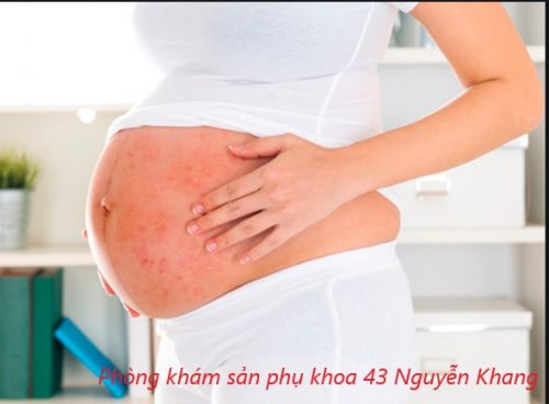 Chẩn đoán và điều trị thủy đậu khi mang thai