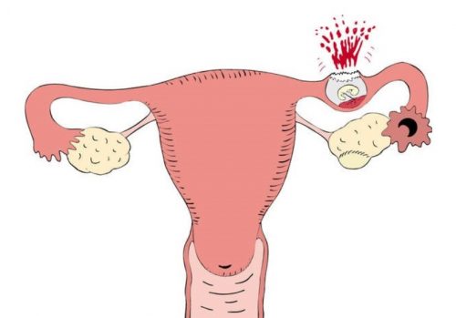 Triệu chứng và phương pháp điều trị thai ngoài tử cung