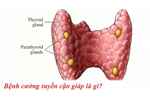 Bệnh cường tuyến cận giáp là gì?