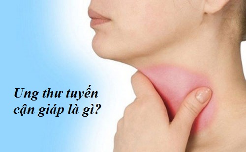 Ung thư tuyến cận giáp là gì?