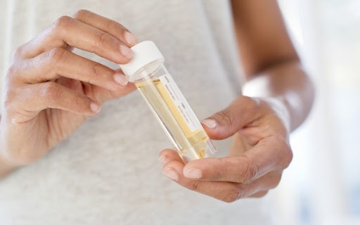 Lưu ý khi thực hiện xét nghiệm Albumin niệu
