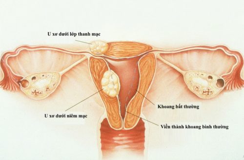 Các biến chứng của chửa trứng ác tính