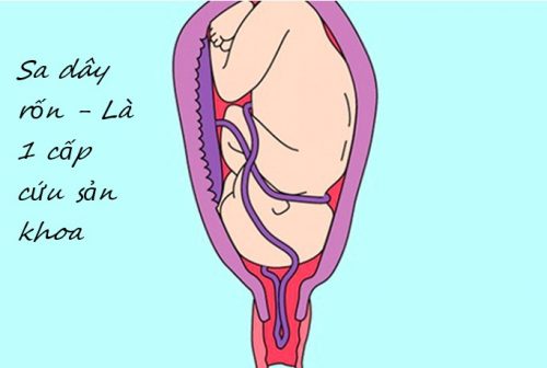 xử trí sa dây rốn