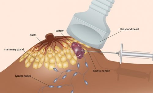 Sinh thiết vú dưới hướng dẫn của siêu âm