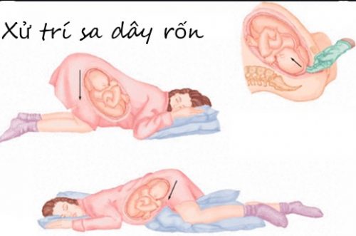 Chẩn đoán và cách xử trí sa dây rốn trong sản khoa