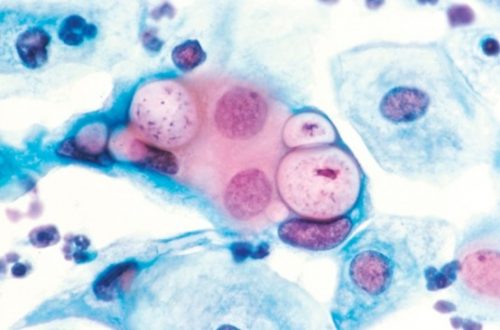 Bệnh do nhiễm Chlamydia Trachomatis ở phụ nữ và trẻ sơ sinh
