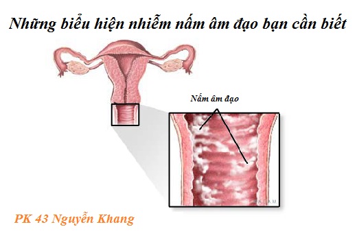 Những biểu hiện nhiễm nấm âm đạo bạn cần biết