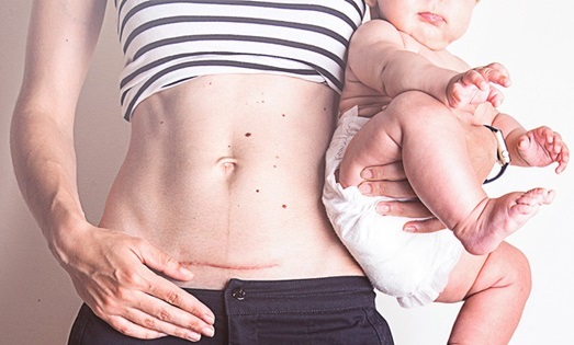 Một số câu hỏi thường gặp về vấn đề sinh mổ