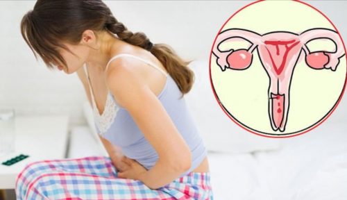 Nguyên nhân gây ra bệnh ung thư cổ tử cung