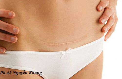 Lưu ý những điều sau để người mẹ nhanh lành vết mổ sau sinh