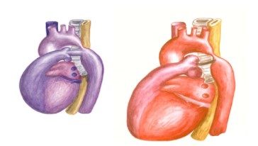 dị tật bim bẩm sinh
