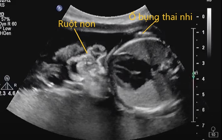 hở thành bụng bẩm sinh