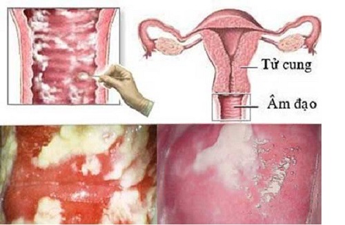 Viêm âm đạo do nấm có điều trị được dứt điểm?