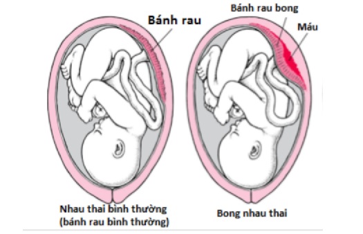 Làm sao để hạn chế được tình trạng nhau bong non
