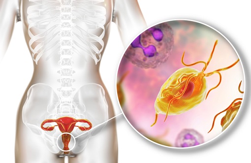 Nhiễm trùng roi Trichomonas qua đường nào và cách điều trị?