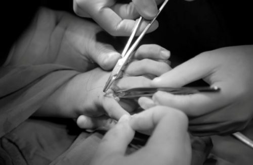 Thời điểm “vàng” phẫu thuật dị tật thừa ngón