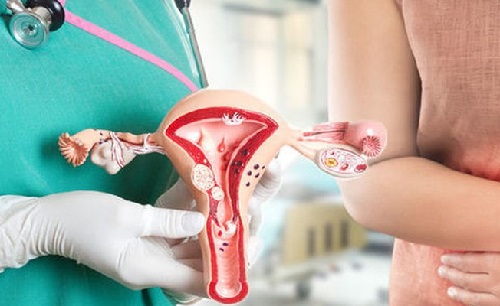 Polyp cổ tử cung có tái phát không?