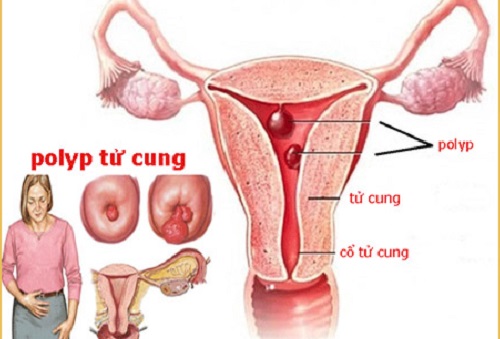 Polyp tử cung là gì? có nguy hiểm không?