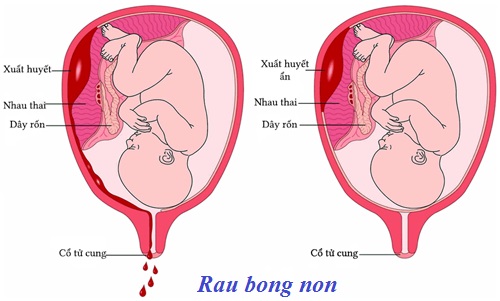 Các thể lâm sàng của rau bong non và hướng xử trí