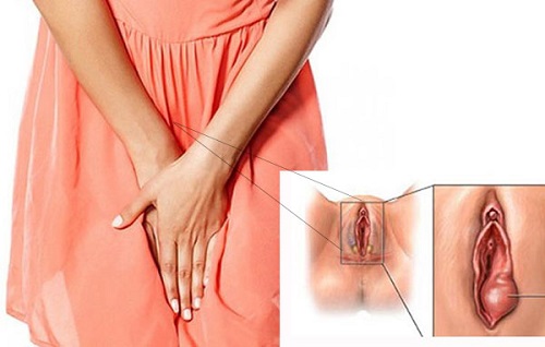 Nguyên nhân sưng vùng kín sau khi quan hệ