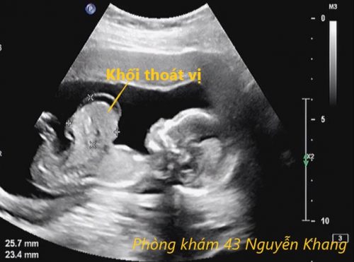 Thai nhi bị thoát vị rốn có nguy hiểm không ?