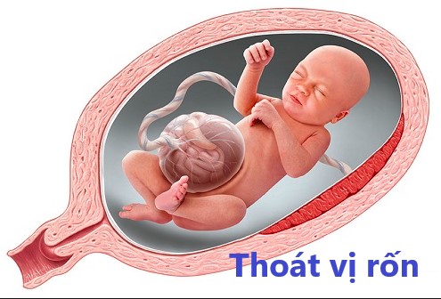 Thoát vị rốn – Dị tật bẩm sinh thường gặp