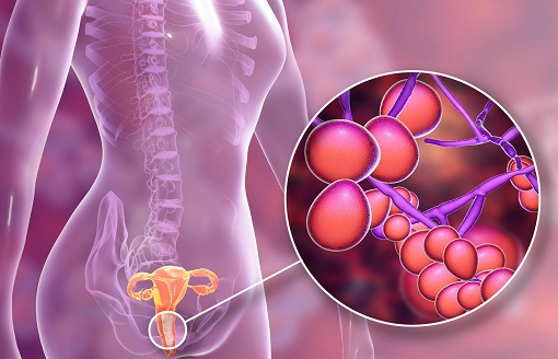 Vì sao phụ nữ hay bị nhiễm nấm candida