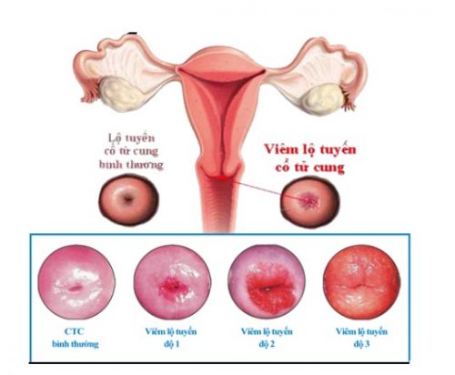 Các cấp độ của viêm lộ tuyến cổ tử cung