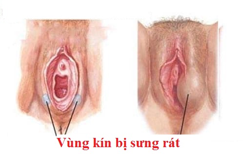 Những nguyên nhân khiến vùng kín bị sưng rát