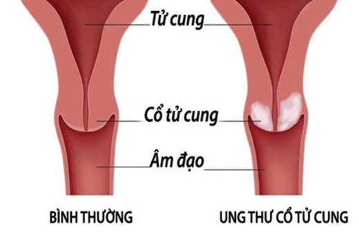 Ung thư cổ tử cung là gì? có phòng tránh được không?