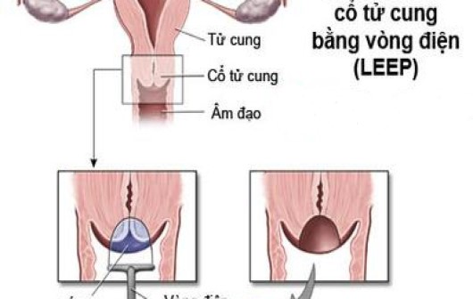 Thực hiện khoét chóp cổ tử cung như thế nào?