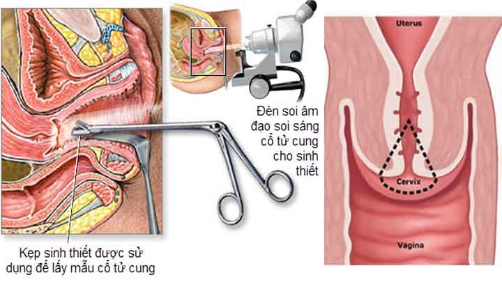 Sinh thiết cổ tử cung là gì?